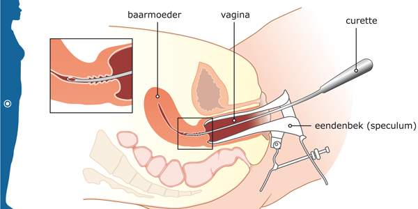 abortus-1