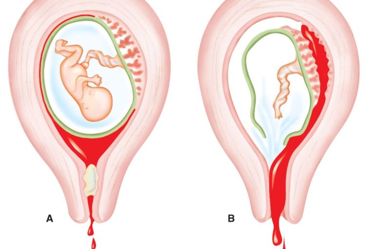 spontan-abortus