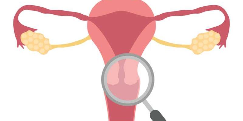 ЕНДОМЕТРИОЗА