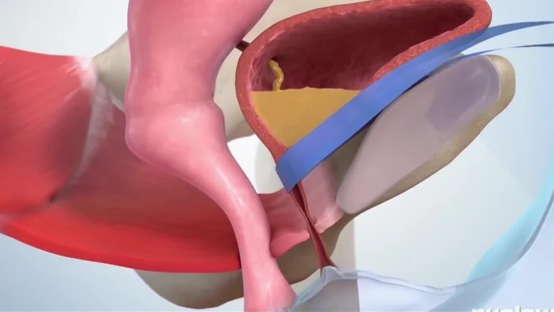 urinarna inkontinencija